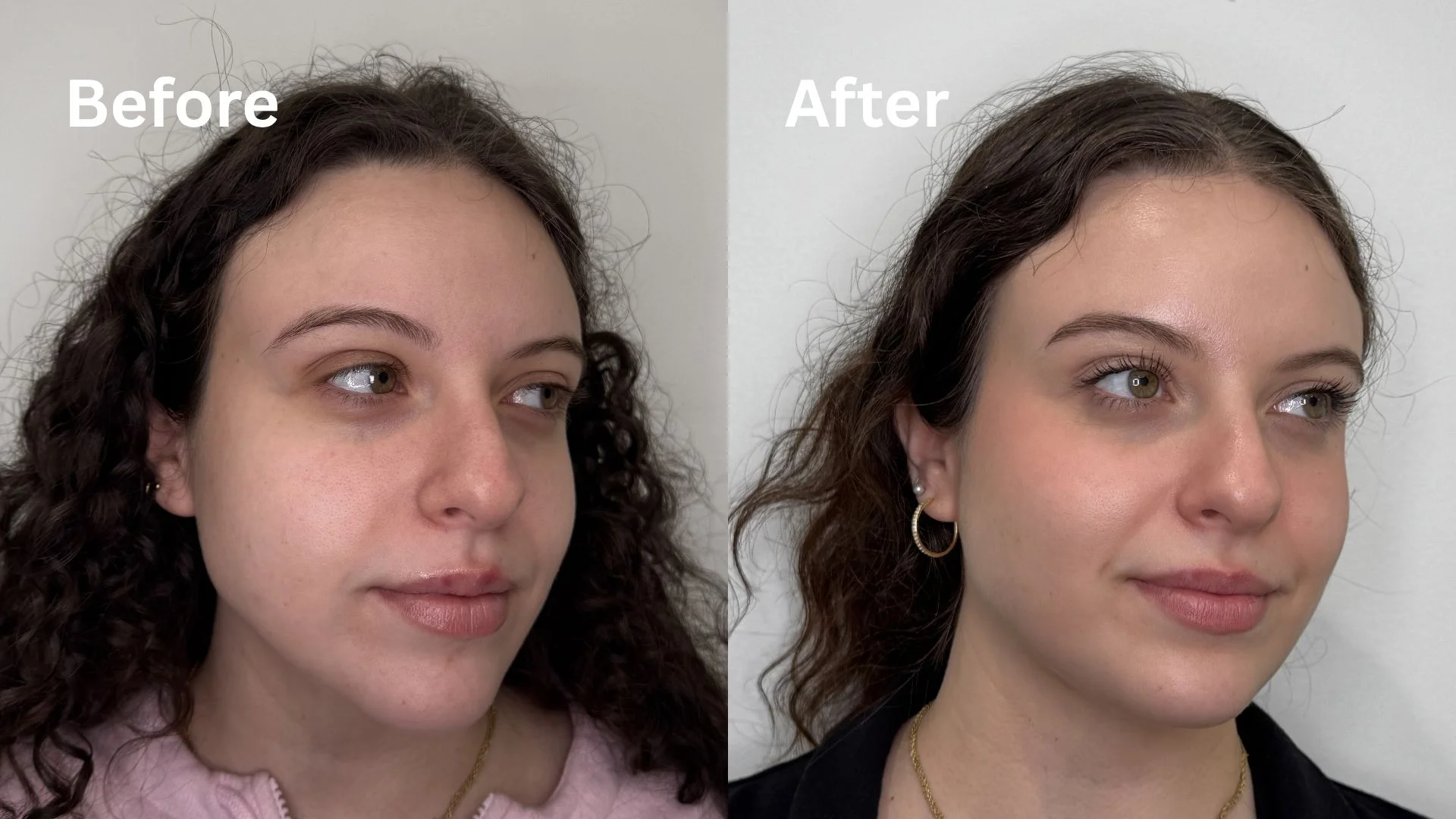 Regenerative Aesthetics before & after treatment